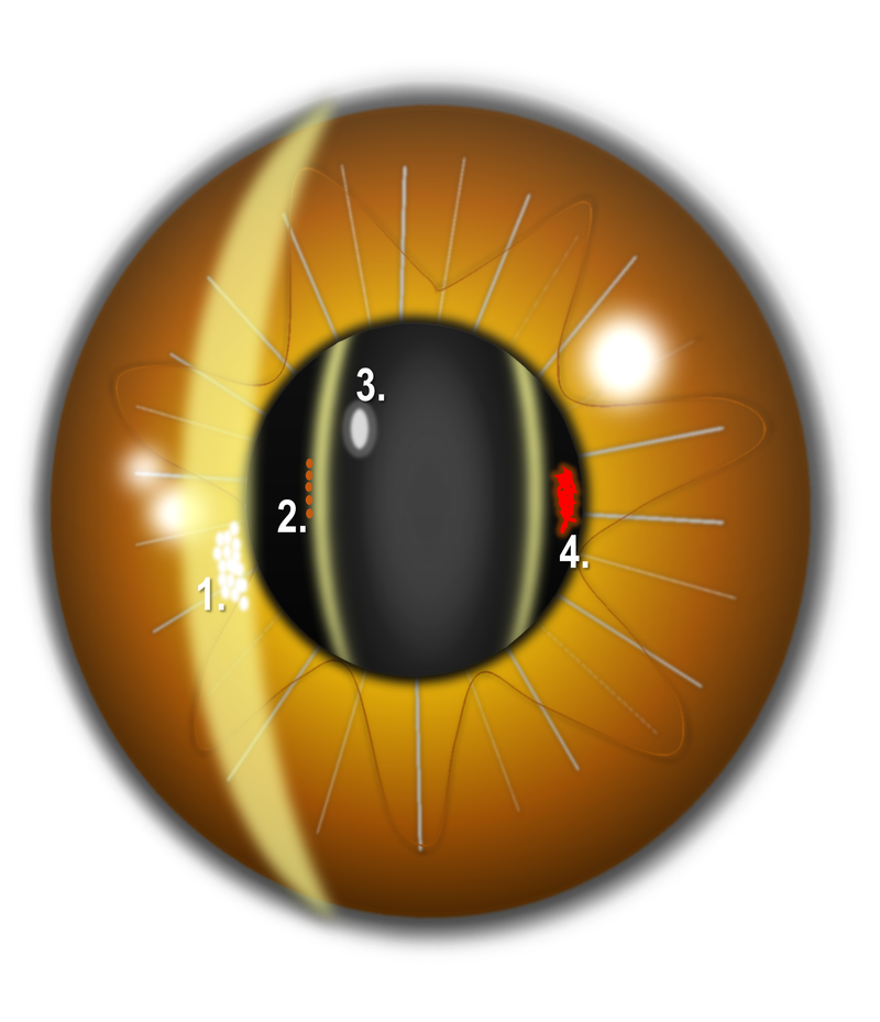 Ein Grafik eines Auges stellt Trübungen im Spaltlicht an den einzelnen Strukturen dar.