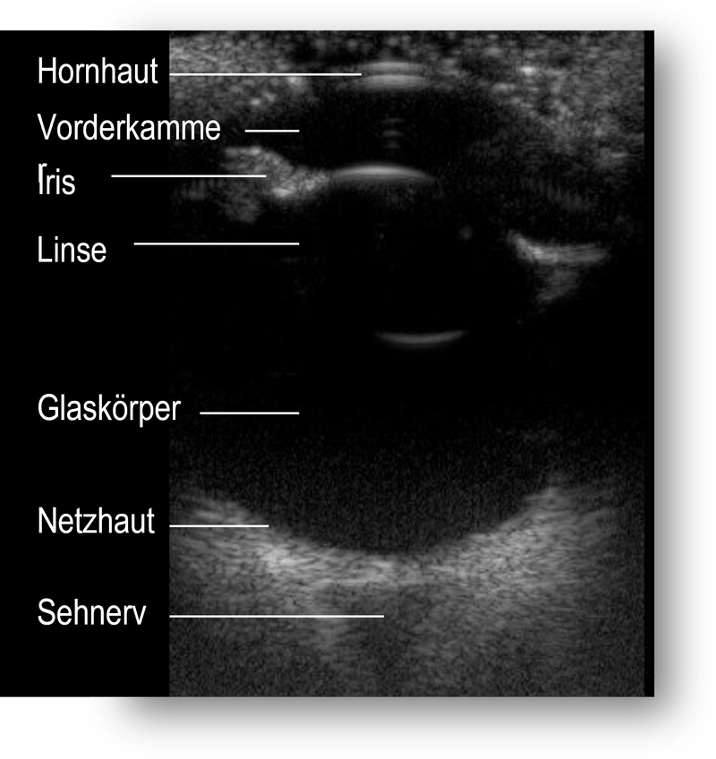 Das Bild zeigt einen ultrasonografischen Schnitt durch das Auge.