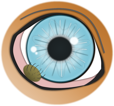 Dermoid