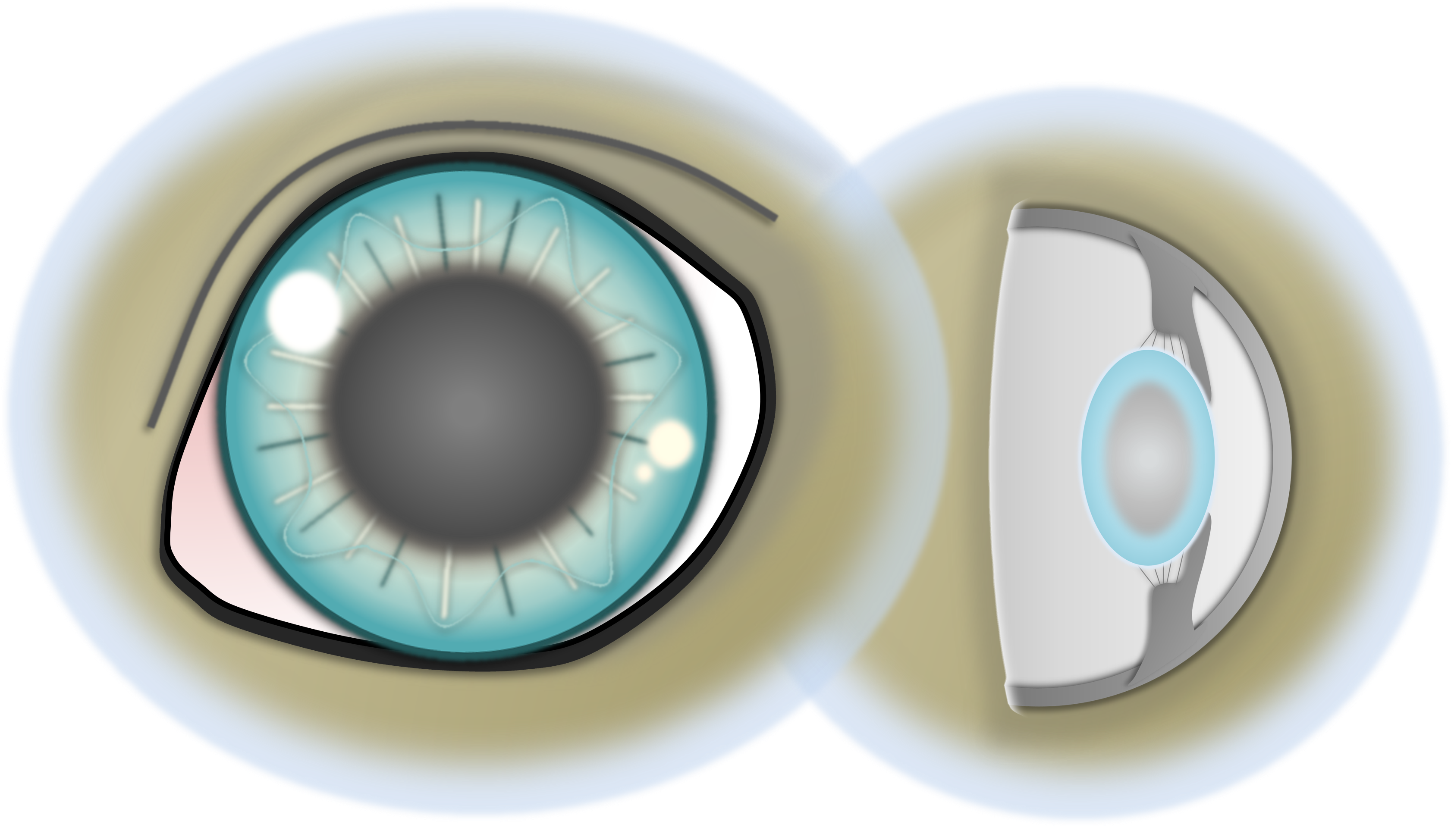 Auge mit gräulicher Trübung der Linse von vorn und im Querschnitt